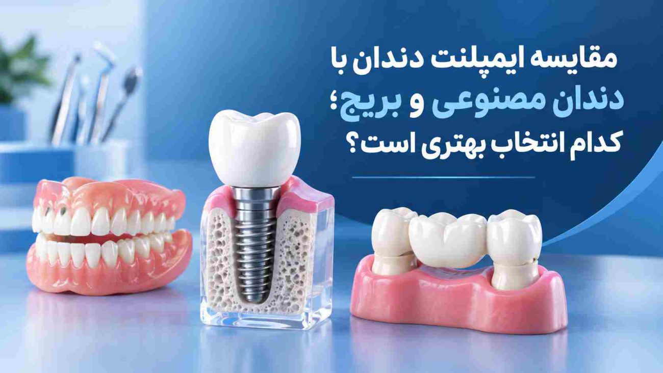 مقایسه ایمپلنت دندان با دندان مصنوعی و بریج؛ کدام انتخاب بهتری است؟