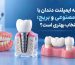 مقایسه ایمپلنت دندان با دندان مصنوعی و بریج؛ کدام انتخاب بهتری است؟